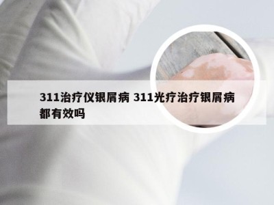 311治疗仪银屑病 311光疗治疗银屑病都有效吗