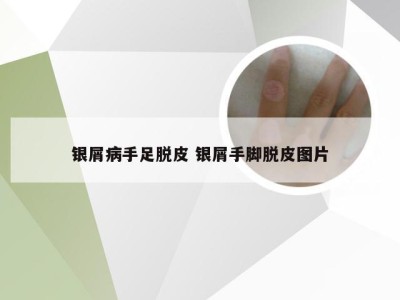 银屑病手足脱皮 银屑手脚脱皮图片
