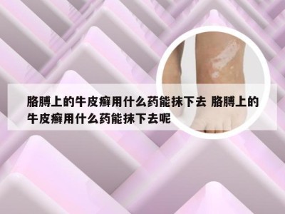胳膊上的牛皮癣用什么药能抹下去 胳膊上的牛皮癣用什么药能抹下去呢