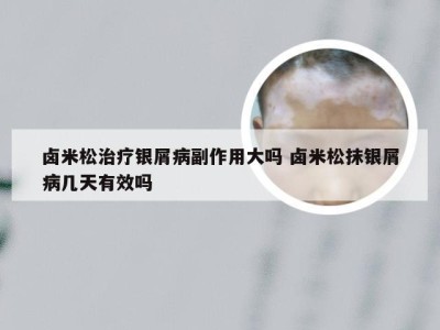 卤米松治疗银屑病副作用大吗 卤米松抹银屑病几天有效吗
