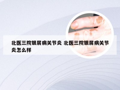北医三院银屑病关节炎 北医三院银屑病关节炎怎么样