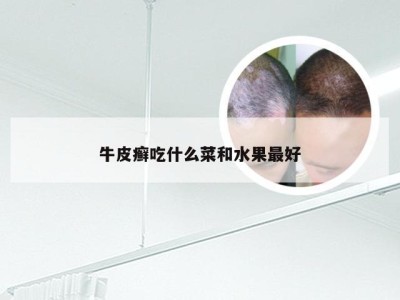 牛皮癣吃什么菜和水果最好