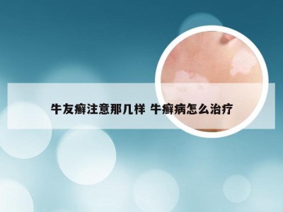 牛友癣注意那几样 牛癣病怎么治疗