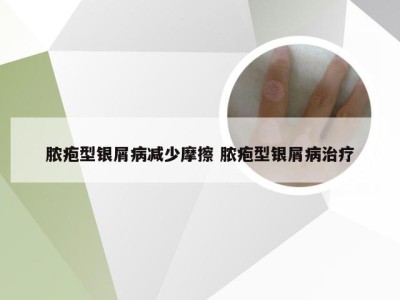 脓疱型银屑病减少摩擦 脓疱型银屑病治疗