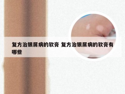 复方治银屑病的软膏 复方治银屑病的软膏有哪些