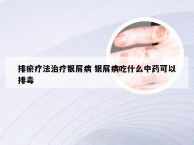 排瘀疗法治疗银屑病 银屑病吃什么中药可以排毒