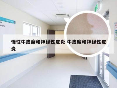 慢性牛皮癣和神经性皮炎 牛皮廨和神经性皮炎