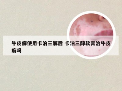 牛皮癣使用卡泊三醇后 卡泊三醇软膏治牛皮癣吗