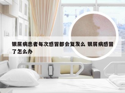 银屑病患者每次感冒都会复发么 银屑病感冒了怎么办