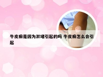 牛皮癣是因为淤堵引起的吗 牛皮癣怎么会引起