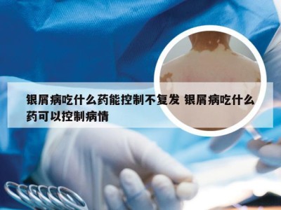 银屑病吃什么药能控制不复发 银屑病吃什么药可以控制病情