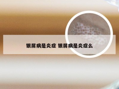 银屑病是炎症 银屑病是炎症么