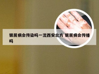 银屑病会传染吗一流西安北方 银屑病会传播吗