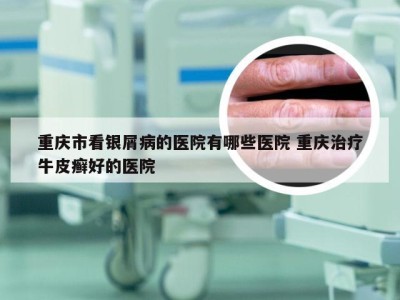 重庆市看银屑病的医院有哪些医院 重庆治疗牛皮癣好的医院