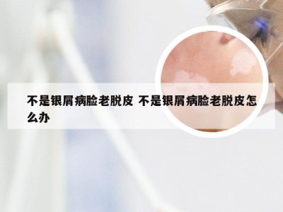 不是银屑病脸老脱皮 不是银屑病脸老脱皮怎么办