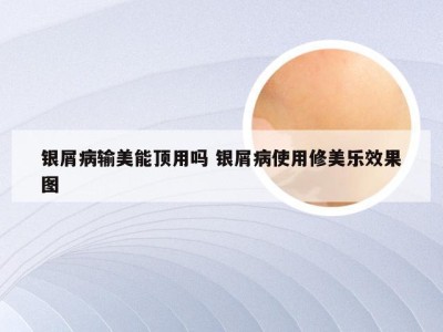 银屑病输美能顶用吗 银屑病使用修美乐效果图