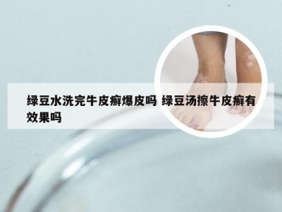 绿豆水洗完牛皮癣爆皮吗 绿豆汤擦牛皮癣有效果吗