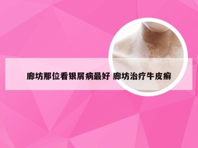 廊坊那位看银屑病最好 廊坊治疗牛皮癣
