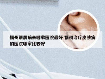 福州银屑病去哪家医院最好 福州治疗皮肤病的医院哪家比较好