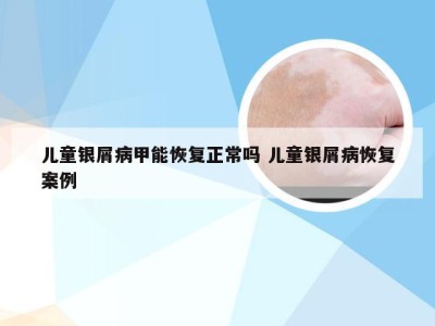 儿童银屑病甲能恢复正常吗 儿童银屑病恢复案例