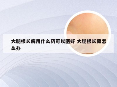 大腿根长癣用什么药可以医好 大腿根长藓怎么办