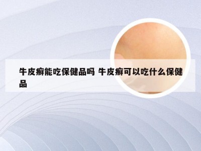 牛皮癣能吃保健品吗 牛皮癣可以吃什么保健品