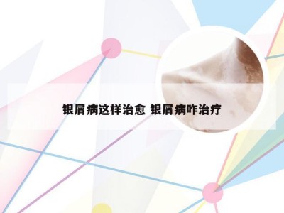银屑病这样治愈 银屑病咋治疗