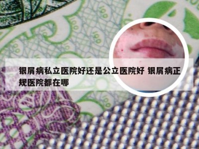 银屑病私立医院好还是公立医院好 银屑病正规医院都在哪