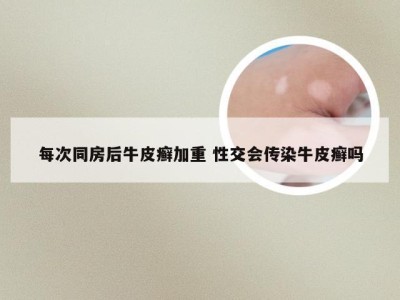 每次同房后牛皮癣加重 性交会传染牛皮癣吗
