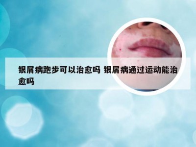 银屑病跑步可以治愈吗 银屑病通过运动能治愈吗