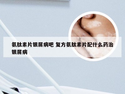 氨肽素片银屑病吧 复方氨肽素片配什么药治银屑病