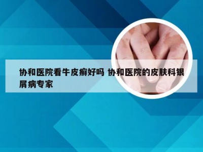 协和医院看牛皮癣好吗 协和医院的皮肤科银屑病专家