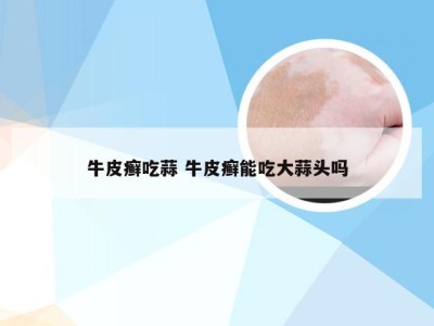 牛皮癣吃蒜 牛皮癣能吃大蒜头吗
