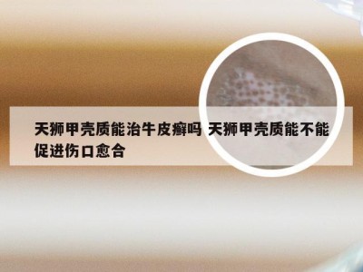 天狮甲壳质能治牛皮癣吗 天狮甲壳质能不能促进伤口愈合