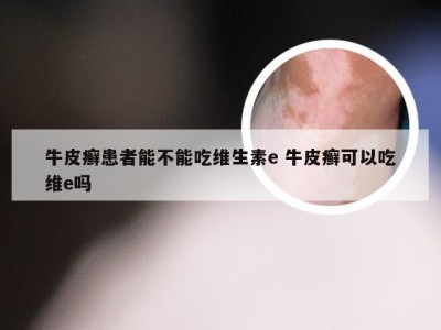 牛皮癣患者能不能吃维生素e 牛皮癣可以吃维e吗