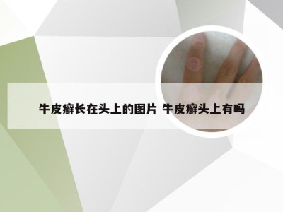 牛皮癣长在头上的图片 牛皮癣头上有吗