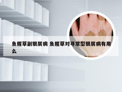鱼腥草副银屑病 鱼腥草对寻常型银屑病有用么
