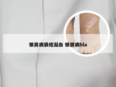 银屑病狼疮凝血 银屑病hla