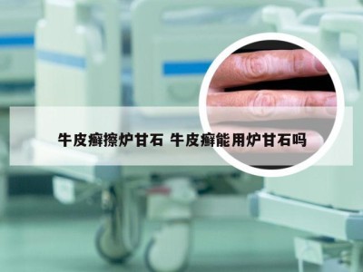 牛皮癣擦炉甘石 牛皮癣能用炉甘石吗