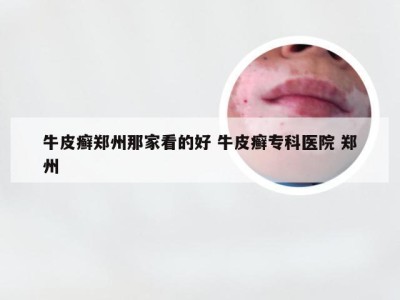 牛皮癣郑州那家看的好 牛皮癣专科医院 郑州