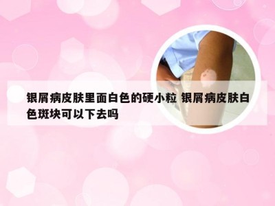 银屑病皮肤里面白色的硬小粒 银屑病皮肤白色斑块可以下去吗