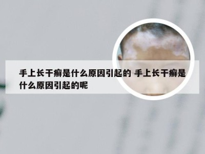 手上长干癣是什么原因引起的 手上长干癣是什么原因引起的呢