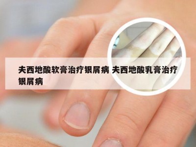 夫西地酸软膏治疗银屑病 夫西地酸乳膏治疗银屑病