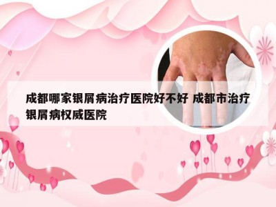 成都哪家银屑病治疗医院好不好 成都市治疗银屑病权威医院