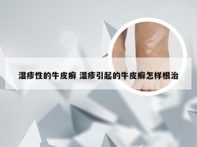 湿疹性的牛皮癣 湿疹引起的牛皮癣怎样根治