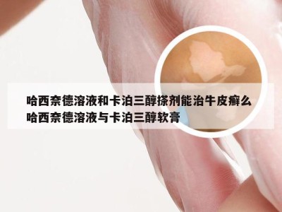哈西奈德溶液和卡泊三醇搽剂能治牛皮癣么 哈西奈德溶液与卡泊三醇软膏