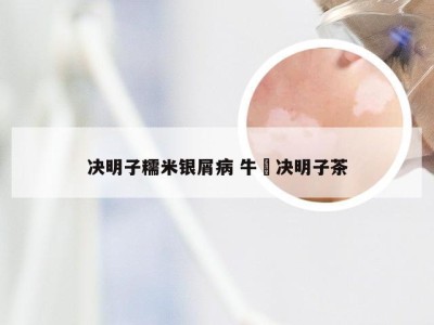 决明子糯米银屑病 牛篣决明子茶