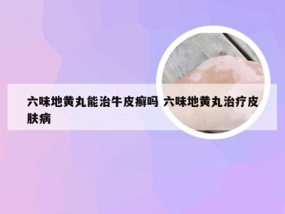 六味地黄丸能治牛皮癣吗 六味地黄丸治疗皮肤病