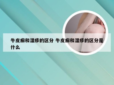 牛皮癣和湿疹的区分 牛皮癣和湿疹的区分是什么