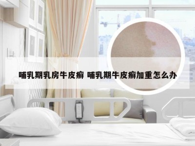 哺乳期乳房牛皮癣 哺乳期牛皮癣加重怎么办